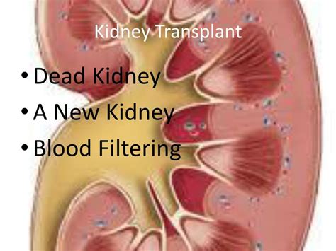 Ppt Kidney Transplant Powerpoint Presentation Free Download Id5073640