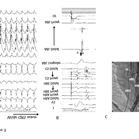 Pdf Electrophysiological Features And Radiofrequency Catheter Ablation Of Accessory Pathways