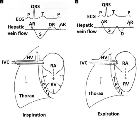 Diagrammatic Representation Of Mechanism Of Diastolic Reversal In