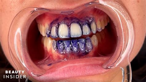 Purple Teeth Stains Can Temporarily Brighten Yellow Stains Beauty