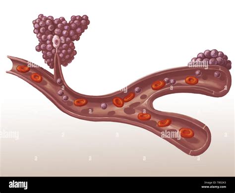 Metastasis Of A Tumor Illustration Stock Photo Alamy