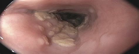 S2775 Not All White Is Candida Herpes Esophagitis Mimicking