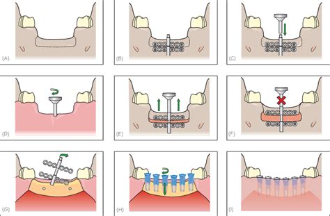 42 Bone Augmentation Alveolar Distraction Osteogenesis Pocket Dentistry