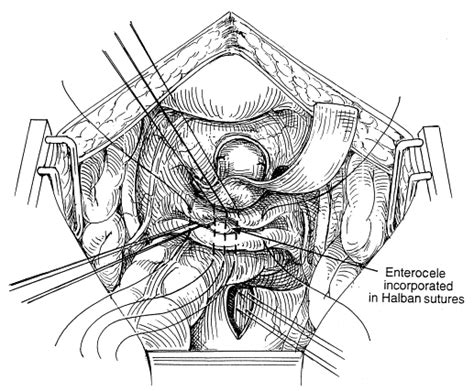 Abdominal Sacral Colpopexy And Abdominal Enterocele Repair In The