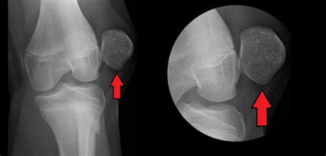 Patellar Dislocation: Does Surgery Give Best Results? | Orthopedics ...