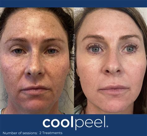 Co Coolpeel Laser In Nashville Tn Belcourt Aesthetics