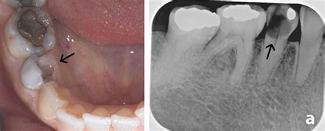 Tooth In A Day Broken Tooth With Cavity Mint Hill Dentistry