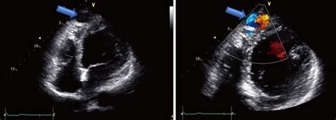 Coronary Cameral Fistula Statpearls Ncbi Bookshelf