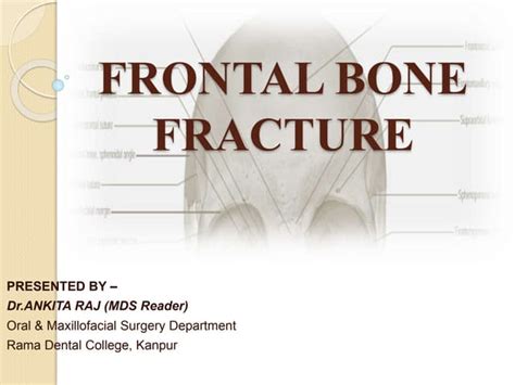 FRONTAL BONE FRACTURE | PPT