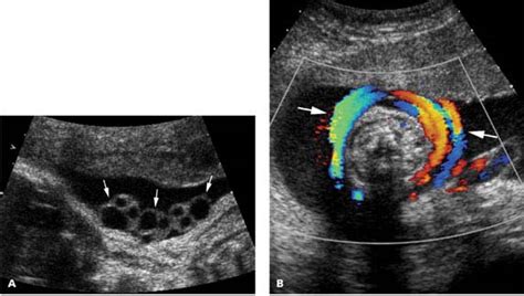 Umbilical Cord Radiology Key