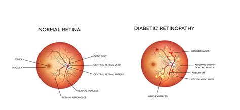 Detect Diabetes | Mountain Eye Care