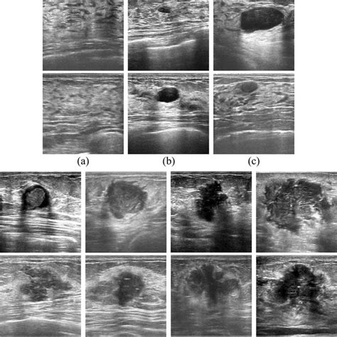 Examples Of Breast Ultrasound Images From Seven Bi Rads Categories