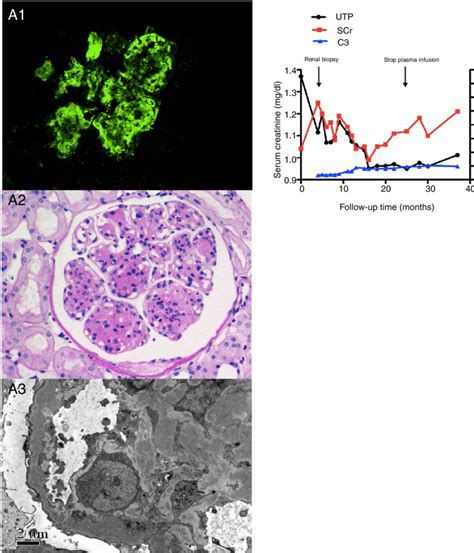 Fig A Renal Biopsy Findings Of The Patient A Granular C C