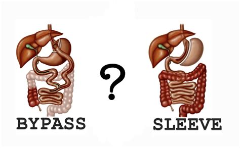 Bypass Ou Sleeve Qual A Melhor Técnica Cirurgia Bariátrica E