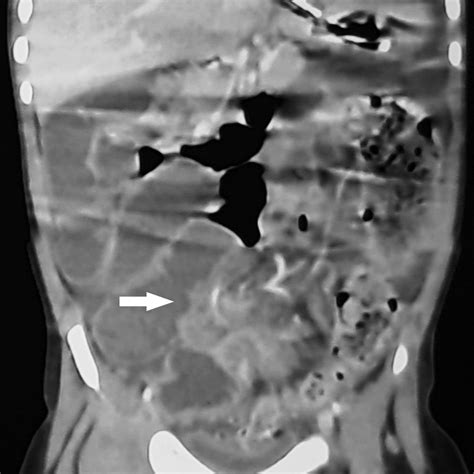 Small Bowel Internal Hernia And Sigmoid Volvulus Through A Congenital Mesenteric Defect The