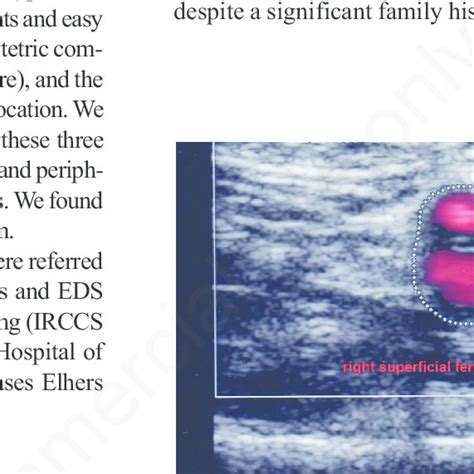 Doppler ultrasound showing right external iliac artery dissection in a ...