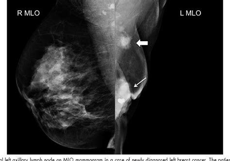 Figure 2 From Imaging Axillary Lymph Nodes In Patients With Newly Diagnosed Breast Cancer