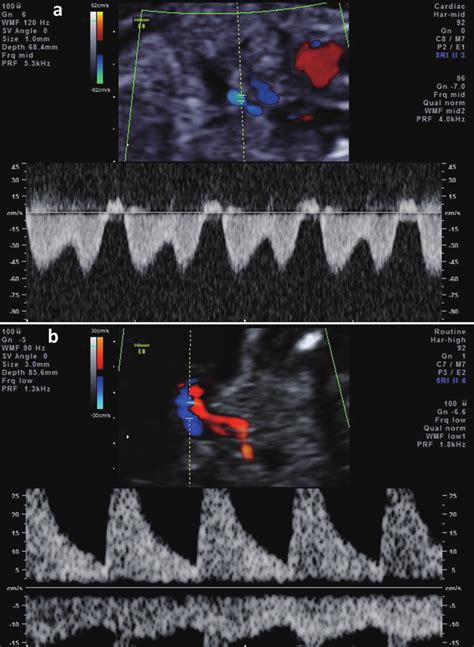 A The Reversed Wave Of Ductus Venosus Before The Admission Of Case 2