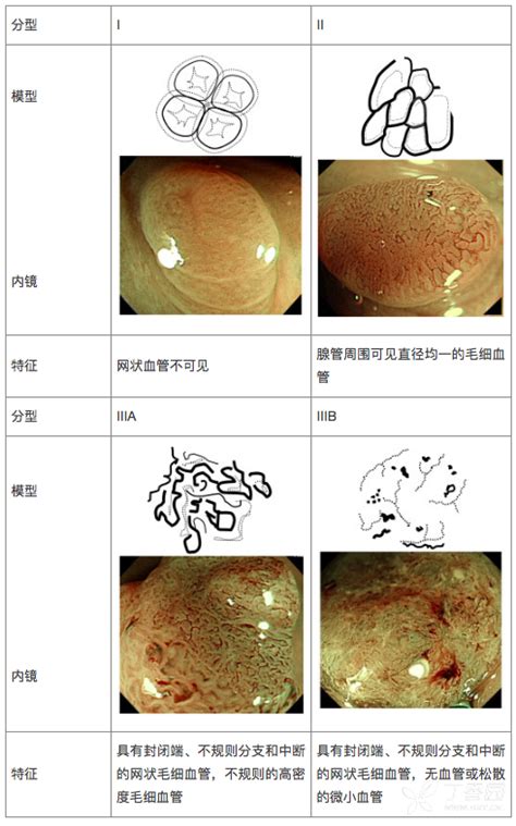 图文详解：结肠息肉切除术 消化内科讨论版 丁香园论坛