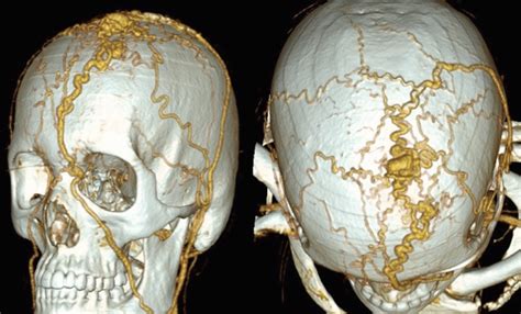 Ct Angiography Of The Vessels Of The Head 3d Reconstruction