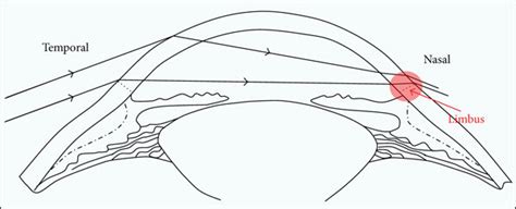 Schematic Representation Of The Peripheral Light Focusing Effect