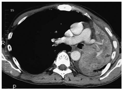 Pneumonectomy | Thoracic Key