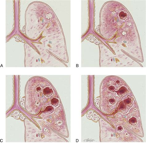 Tuberculosis Thoracic Key