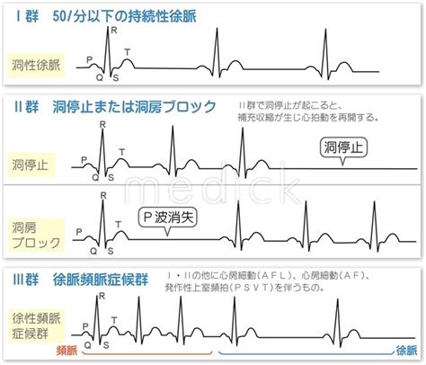 徐脈性不整脈・その1 高橋医院