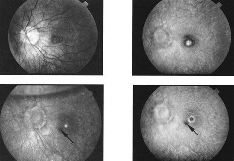 Translocation Of The Macula For Management Of Subfoveal Choroidal