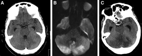 Diagnosis and Management of Acute Cerebellar Infarction | Stroke