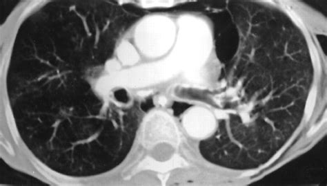 Pneumomediastinum Revisited Radiographics