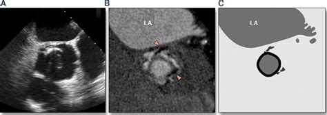 Imaging Of Prosthetic Heart Valve Dysfunction Complementary Diagnostic