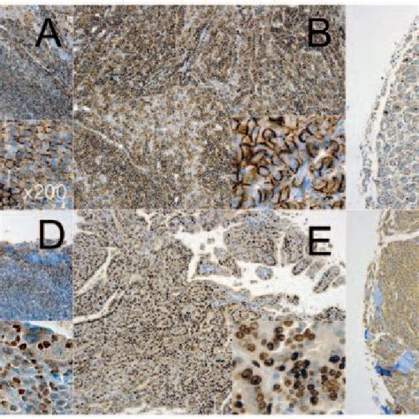 Immunohistochemical Staining Pattern Of Papillary Thyroid Carcinoma