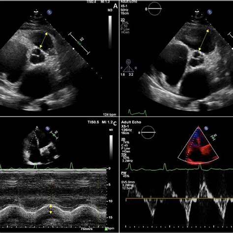 Echocardiographic Measurements Of Right Ventricular And Right