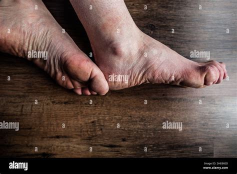 Feet Of Person With Both Raynaud And Ehlers Danlos Eds Syndrome On