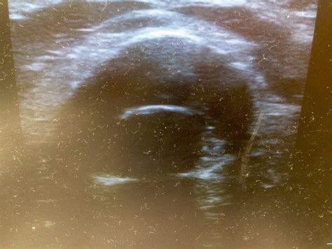 Ultrasound for Confirmation of Endotracheal Tube Placement During CPR ...