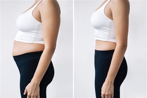 Fat Reduction In Atlanta Ga Peachtree Dermatology Associates