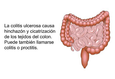 PatEdu Colitis Ulcerosa