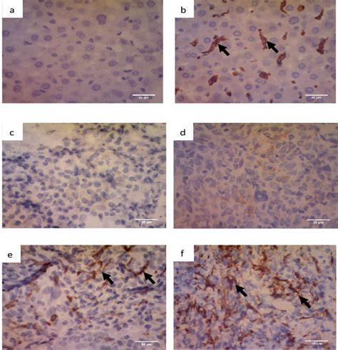 Immunohistochemistry Of M2 Macrophage Using Anti CD163 Antibody