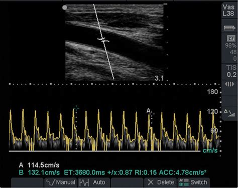 Measurement Of Variation In Carotid Peak Systolic Velocity At 14 In