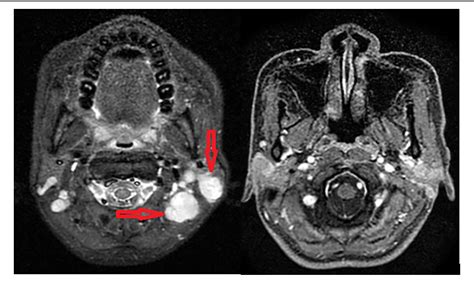 Figure 1 From Rhabdoid Meningioma Metastases Cervical Lymph Nodes A