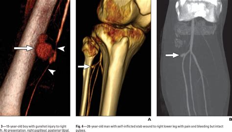 Lower Extremity Angiography