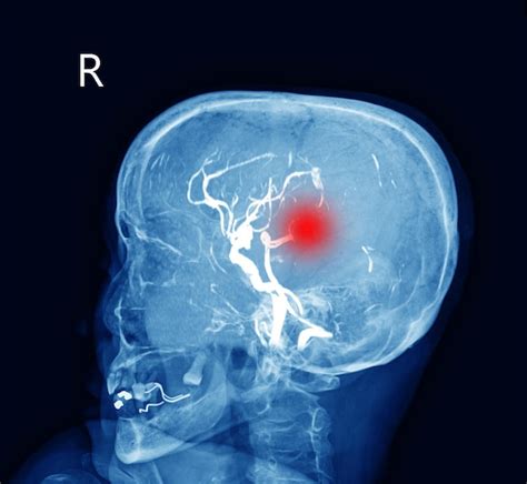 Premium Photo | Mri of the blood vessels in the brain and ...