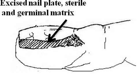 Excision Of Nail Plate Sterile Matrix And Germinal Matrix Download