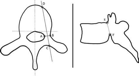 Illustration of thoracic vertebrae showing pedicle depth to anterior ...