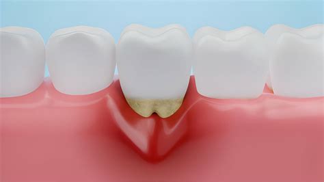 Est Dente Inflamado Saiba Como Tratar E Aliviar A Dor