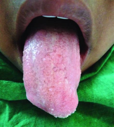 Cavernous Hemangioma Of Tongue Management Of Two Cases Abstract