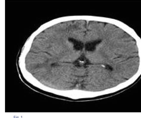 Figure 1 From Monoparesia En Paciente VIH Un Caso De