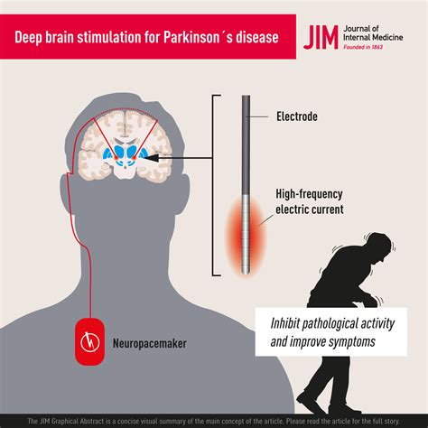 Deep Brain Stimulation For Parkinsons Disease Hariz 2022 Journal