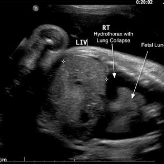 Hydrops Ultrasound